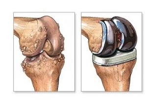 заместване на коляното при артроза