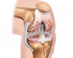 начален стадий на артроза на коляното