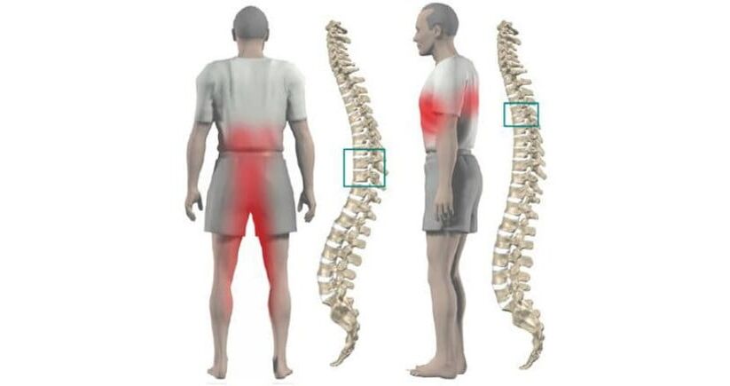 болка в тялото и гръбначния стълб с остеохондроза