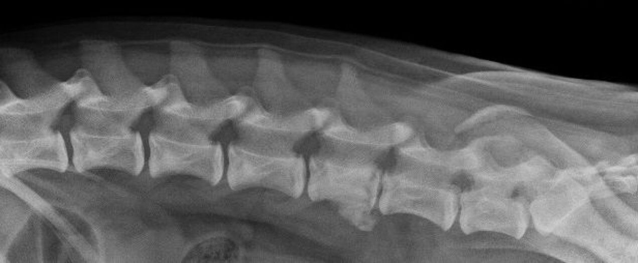 Прояви на остеохондроза на гръдния кош на рентгенова снимка