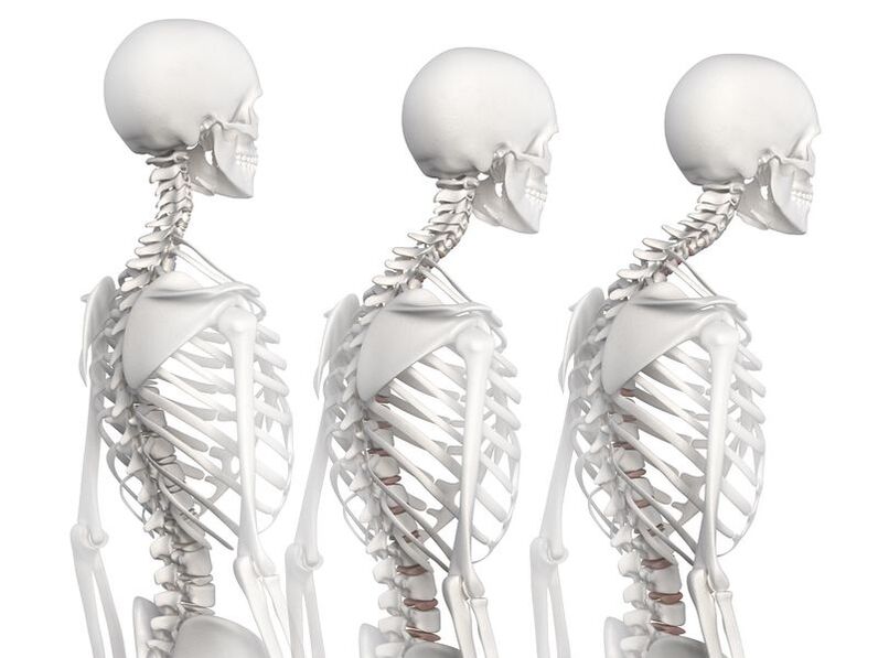 Степени на развитие на гръдна остеохондроза на примера на скелетен модел