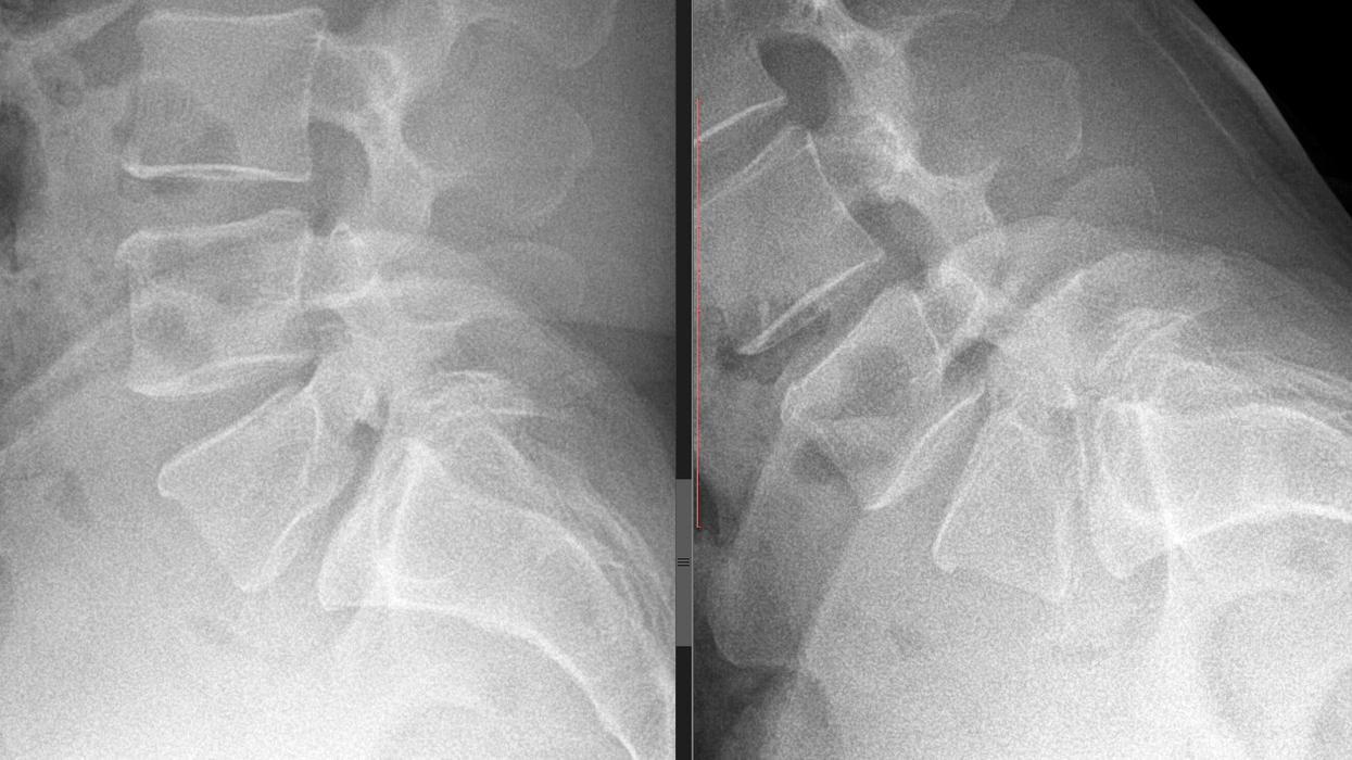 изображение на шийния отдел на гръбначния стълб
